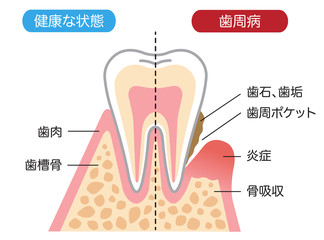 233356094_periodontal-disease.jpg